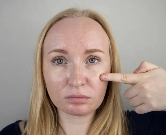 Post-Inflammatory-Hyperpigmentation-pic